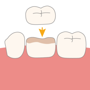 Zahnkronen aus Keramik für Kinder