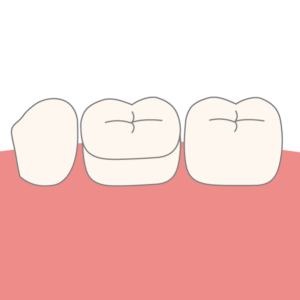 Zahnkronen aus Keramik für Kinder