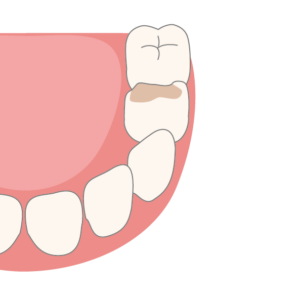 Zahnkronen aus Metall für Kinder