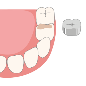 Zahnkronen aus Metall für Kinder