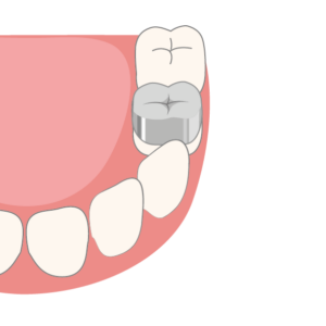 Zahnkronen aus Metall für Kinder